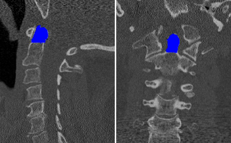 Deep Learning C2 Spinal Fracture Prediction